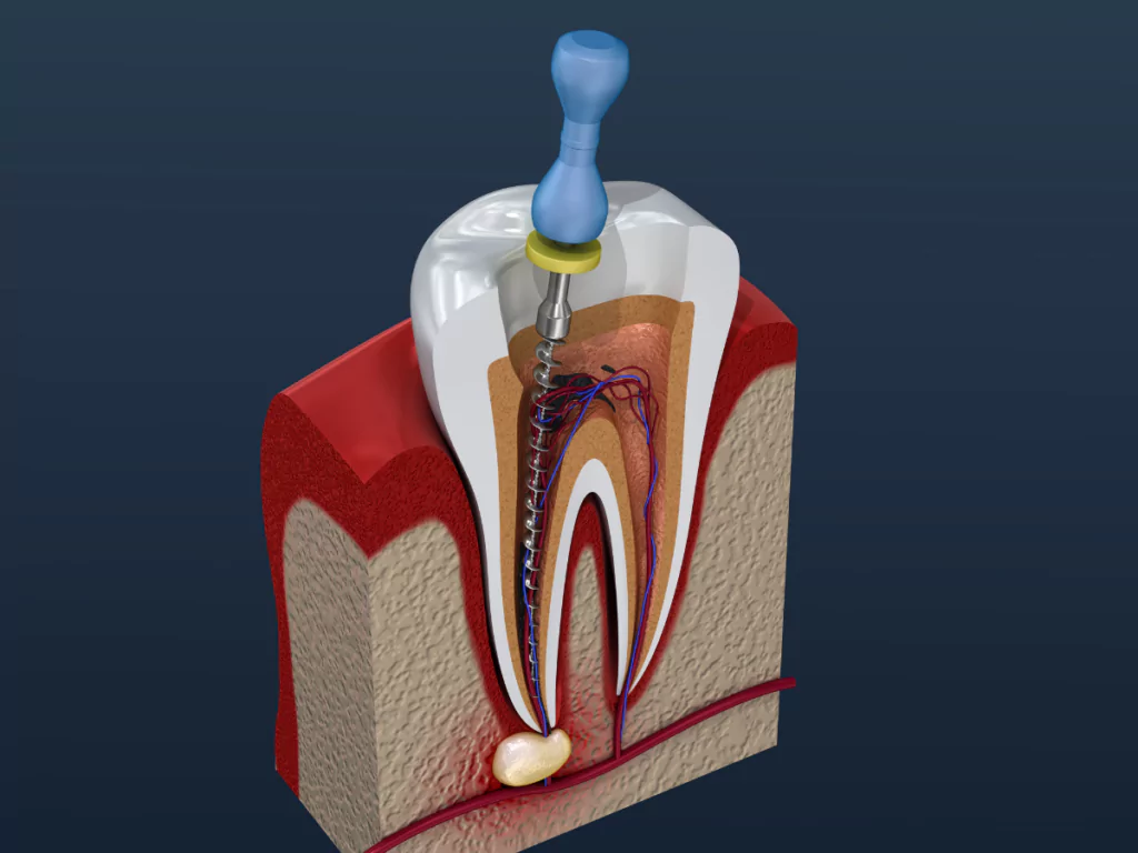 Dental Implants in Everett