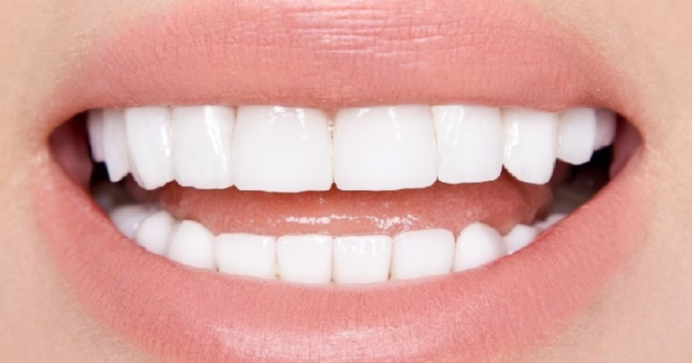 Porcelain-Veneers-in-Everett