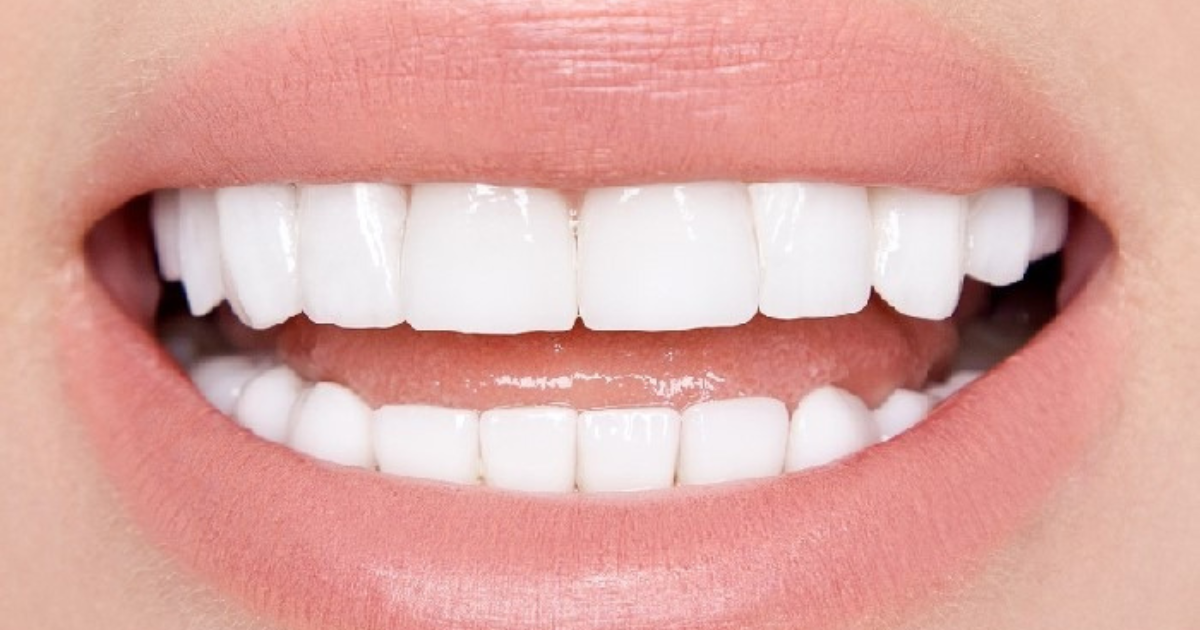 Customizing Your Porcelain Veneers for a Natural-Looking Result