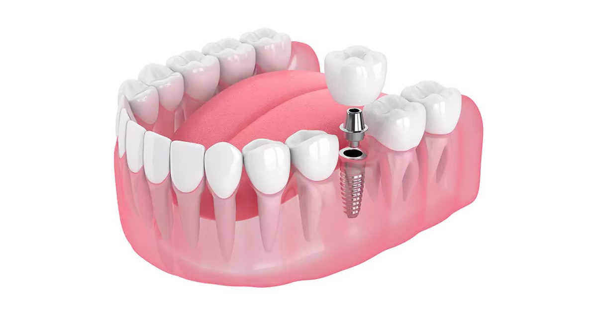 How Implant Dentists Customize Dental Implants to Fit Each Patient’s Needs