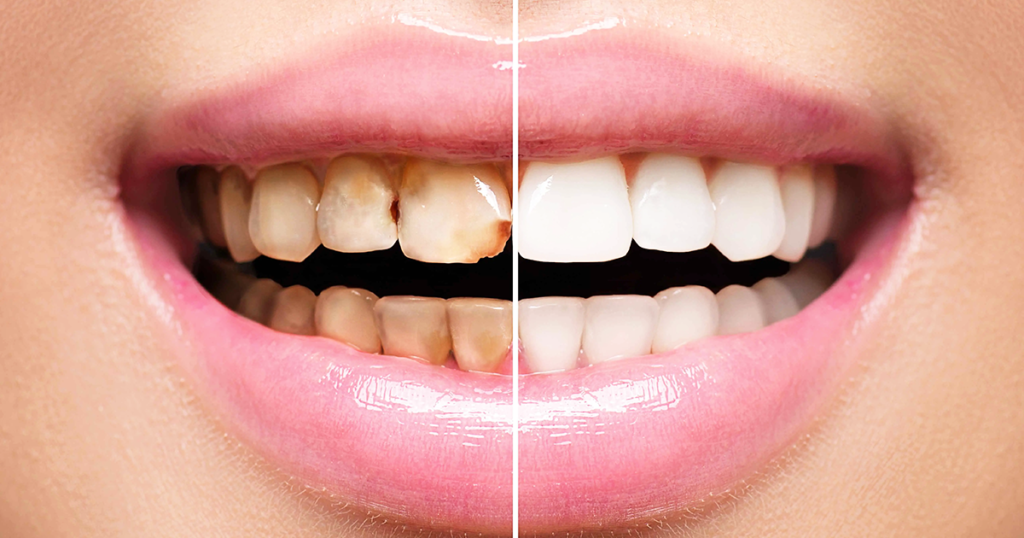 Porcelain Veneers: Transforming Your Smile With Natural-Looking Results